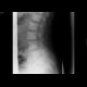 Osteoplastic metastases: X-ray - Plain radiograph